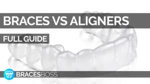 aligners vs braces