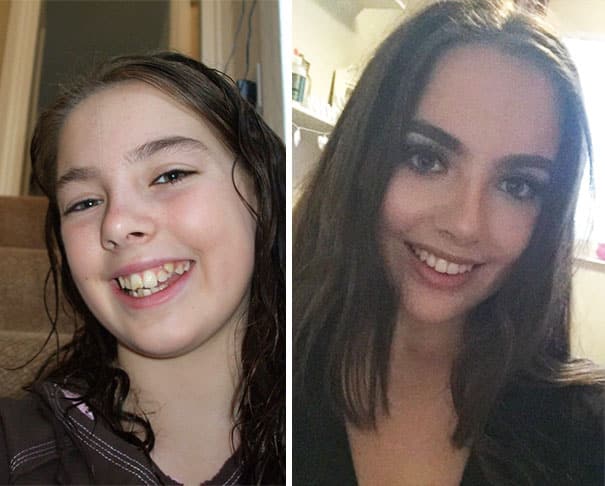 braces before and after results