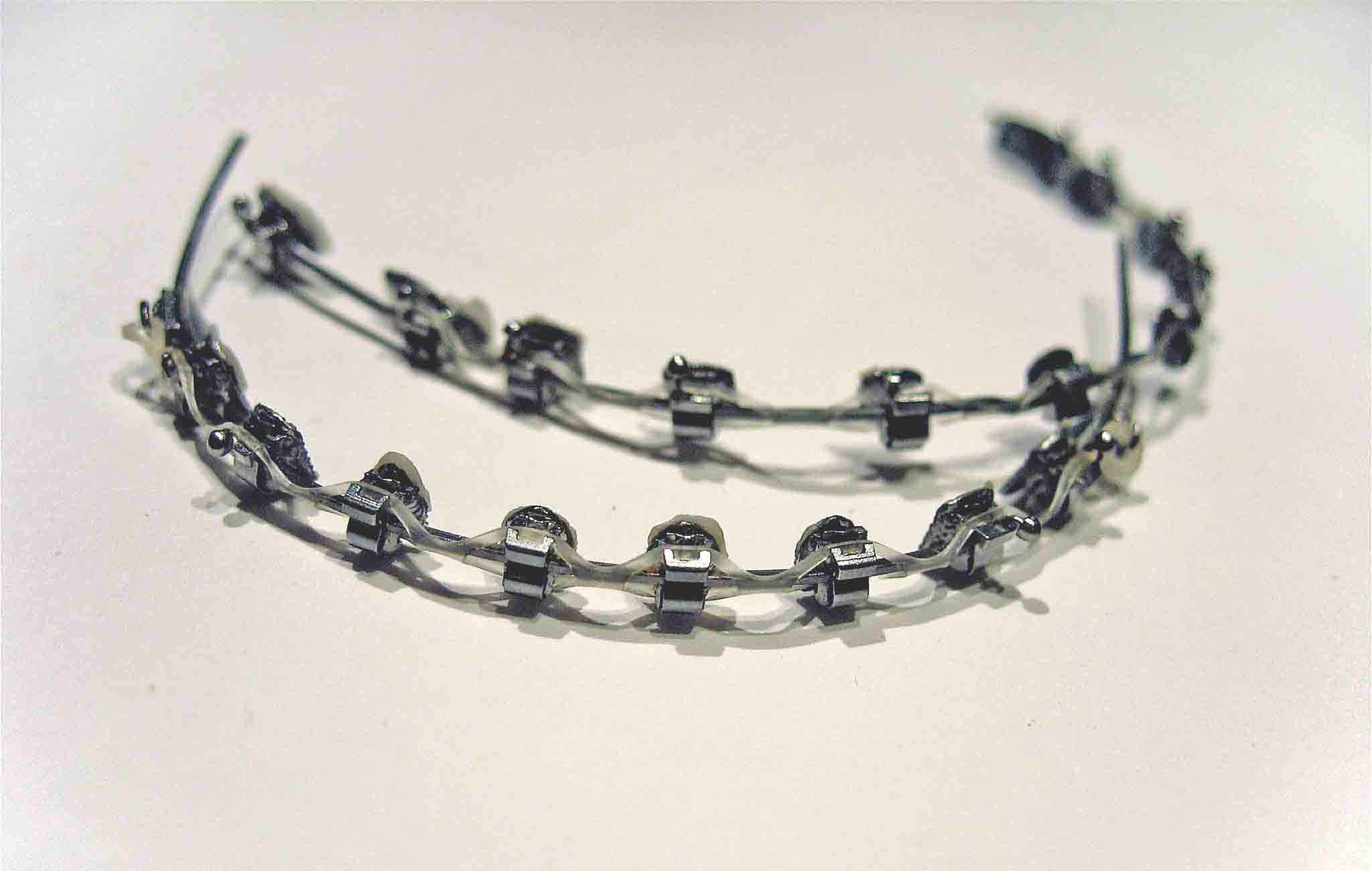 Braces Vs Retainers Full Pro Guide 2025 Bracesboss