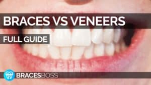 braces vs veneers