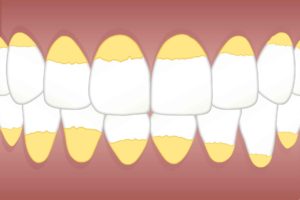 braces yellowing teeth