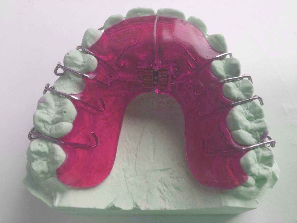 dental braces vs retainer