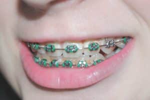 dental braces vs veneers