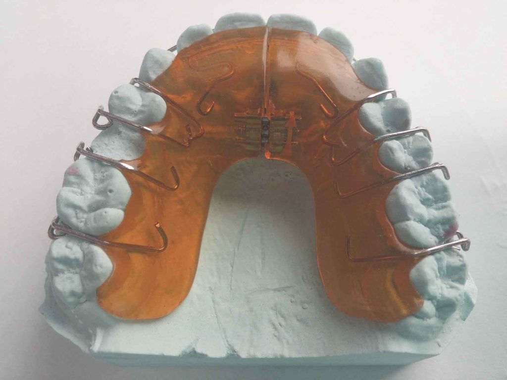 different kinds of braces