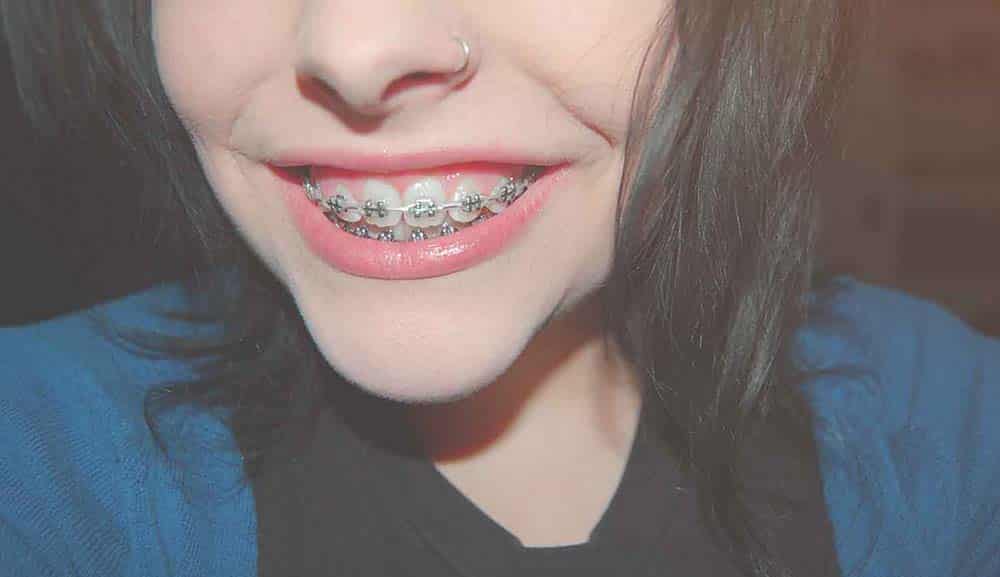 different types of braces for teeth