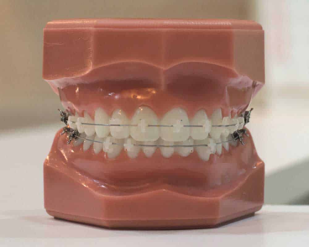 porcelain dental braces